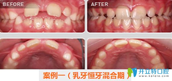 <!--<i data=20240703-sp></i>-->口腔兒童牙齒矯正案例對比圖