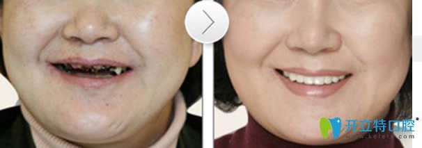 老年人全口種植牙前后對比圖