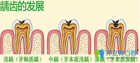 兒童齲齒怎么治療多少錢？齲齒治療預防方法及費用大全