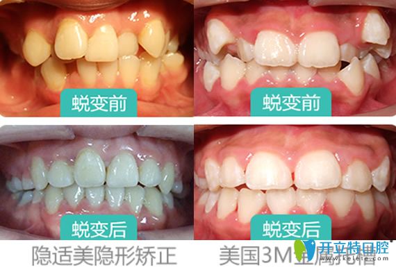 西安牙齒矯正哪家好？看西安雁塔惟真口腔隱適美矯正+金屬托槽矯正案例