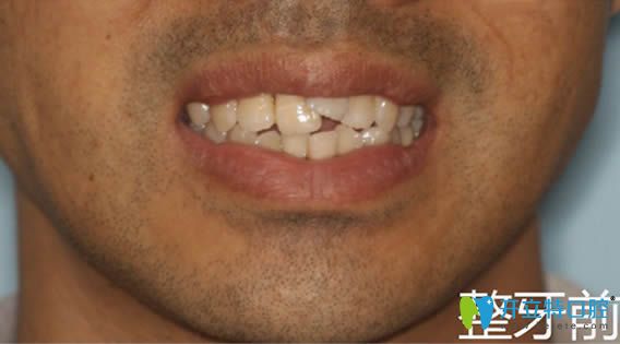 我比較過陶瓷和金屬托槽的區(qū)別,去北京牙管家做半隱形矯正