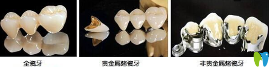 烤瓷牙哪種好多少錢一顆？分享烤瓷牙的種類和價(jià)格表