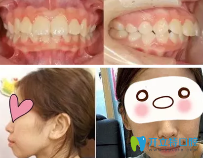 上?？泼揽谇辉趺礃樱靠戳宋?8歲牙齒矯正前后照片真是后悔
