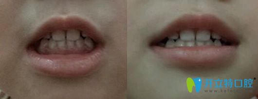 <!--<i data=20240703-sp></i>-->口腔3歲女童牙齒矯正1個(gè)月后照片