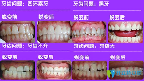 惟真口腔DSD數(shù)字美學(xué)瓷貼面案例治療前后效果對比