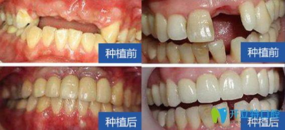 西安雁塔惟真口腔怎么樣？百萬真實(shí)案例，彰顯種植優(yōu)勢