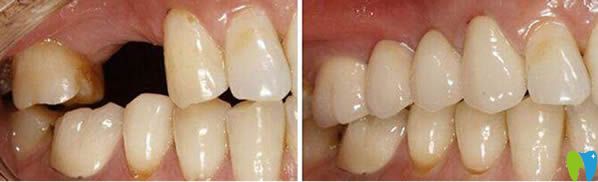 北京美年口腔黃俊淋主任單顆牙缺失種植牙前后對(duì)比效果