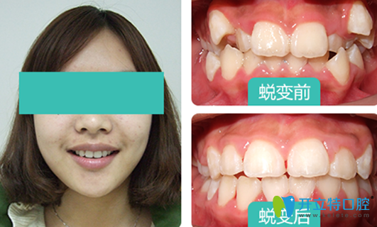 19歲在校<!--<i data=20240703-sp></i>-->生在西安雁塔惟真口腔做牙齒矯正案例