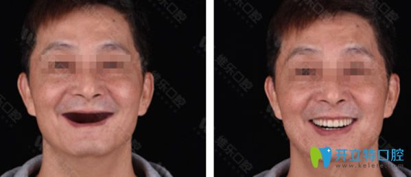 <!--<i data=20240703-sp></i>-->維樂(lè)口腔種植牙效果案例