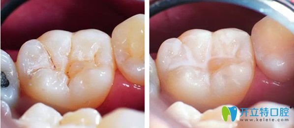 <!--<i data=20240703-sp></i>-->維樂(lè)口腔根管治療齲齒補(bǔ)牙后效果