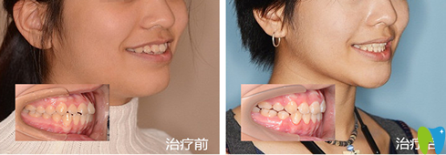 恩吉口腔牙齒矯正前后效果對比圖 恩吉口腔牙齒矯正前后效果對比圖