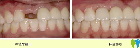 寧波恩吉口腔種植牙前后效果對比圖 寧波恩吉口腔種植牙前后效果對比圖
