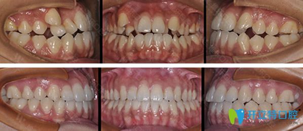 維樂(lè)口腔因金屬托槽矯正牙齒前后效果對(duì)比照