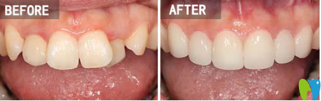 楊國(guó)平醫(yī)生數(shù)字化DAMON快速矯正案例