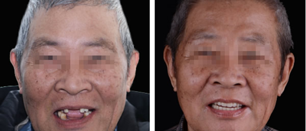 ?西市首富二爺?shù)募傺罁Q成上海維樂(lè)口腔種植牙 效果會(huì)怎樣