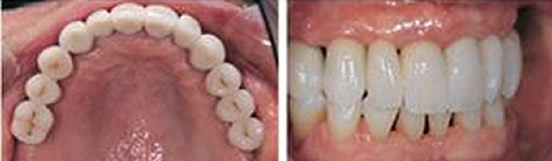 ?趁重慶維樂口腔價格優(yōu)惠 帶半口牙缺失的媽媽做了種植牙