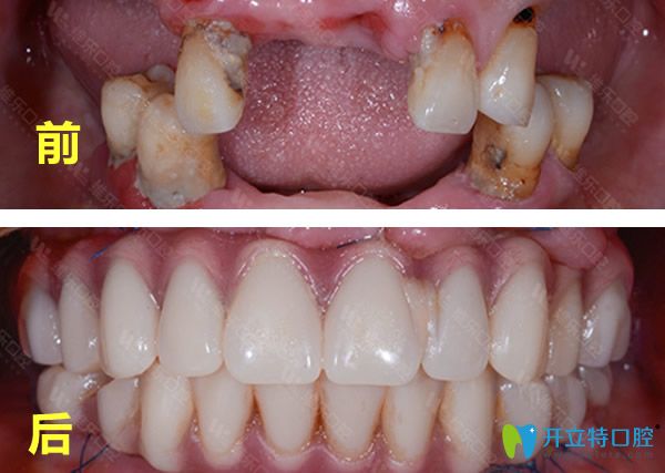 <!--<i data=20240703-sp></i>-->維樂口腔種牙前后的效果對比照