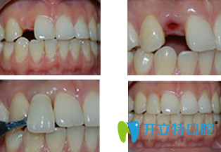 寧波恩吉口腔種植牙齒費(fèi)用便宜效果還好,顧客體驗(yàn)后的評價