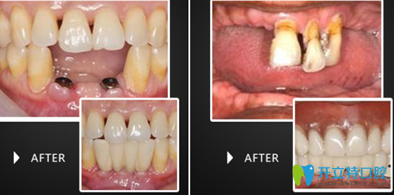 、淮安牙科哪家好點？看牙知道（三淮）口腔牙齒種植案例知