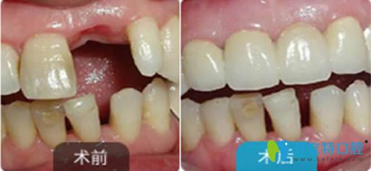 <!--<i data=20240703-sp></i>-->永華口腔單顆牙種植效果圖