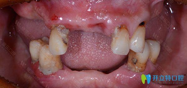 <!--<i data=20240703-sp></i>-->維樂口腔牙齒種植前