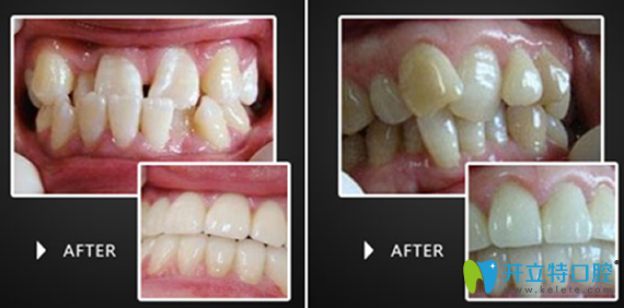 淮安評價好的口腔是哪家？牙知道口腔牙齒矯正治療效果來驗證