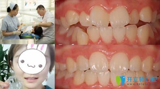 <!--<i data=20240703-sp></i>-->永華口腔隱形牙齒矯正效果對(duì)比圖 <!--<i data=20240703-sp></i>-->永華口腔隱形牙齒矯正效果對(duì)比圖