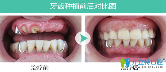 寧波恩吉口腔牛伊南種植牙<span style= 寧波恩吉口腔牛伊南種植牙<span style=