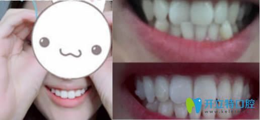 <!--<i data=20240703-sp></i>-->永華齒科牙齒正畸效果對(duì)比照 <!--<i data=20240703-sp></i>-->永華齒科牙齒正畸效果對(duì)比照
