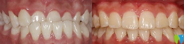 優(yōu)貝口腔隱適美隱形矯正案例