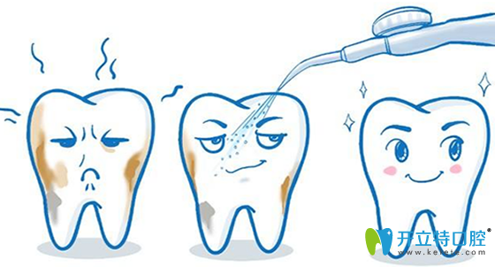 洗牙多少錢(qián)？多久洗牙一次比較好？淮安牙知道醫(yī)生揭秘