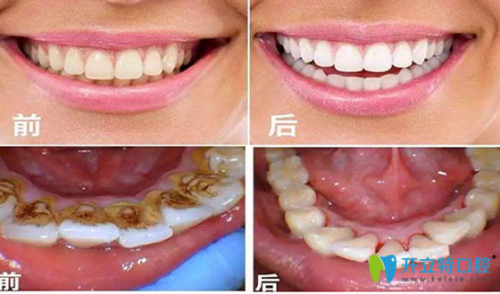 洗牙效果前后對比照片