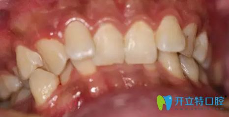 優(yōu)貝口腔牙齒矯正前