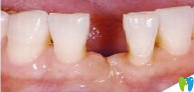 宋鐵礫種植牙治療前