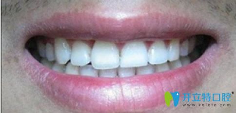 隱形無(wú)托槽牙齒矯正后的效果