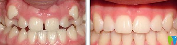 瑞安口腔隱適美隱形矯正案例 瑞安口腔隱適美隱形矯正案例