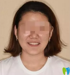 我在沈陽康貝佳口腔做牙齒矯正一年的效果