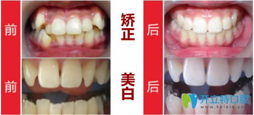 沈陽(yáng)康貝佳隱形牙齒矯正及牙齒美白前后對(duì)比效果圖