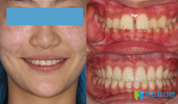 牙列稀疏矯正效果案例 牙列稀疏矯正效果案例