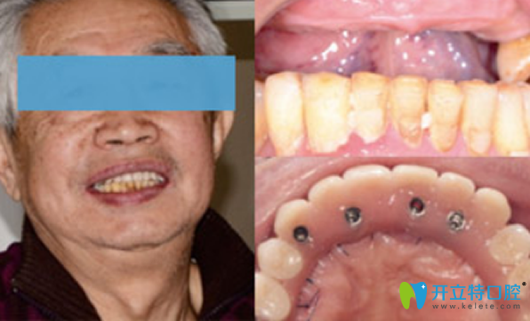 北京拜博口腔半口牙缺失種植效果 北京拜博口腔半口牙缺失種植效果