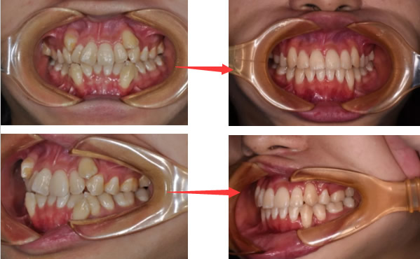 30多歲還能矯正牙齒嗎要多久 看我在鄭州拜博口腔正畸過程