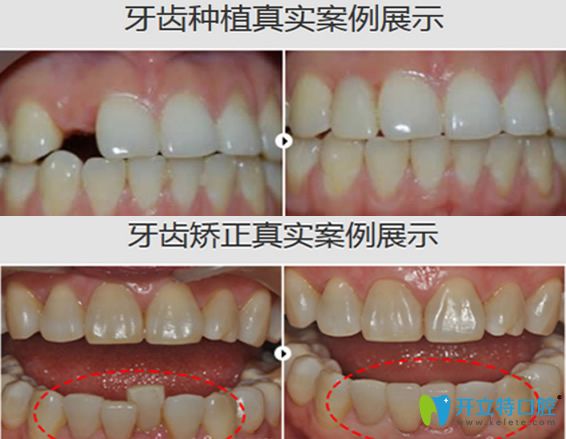 海濤口腔牙齒種植+牙齒矯正案例前后對(duì)比圖展示