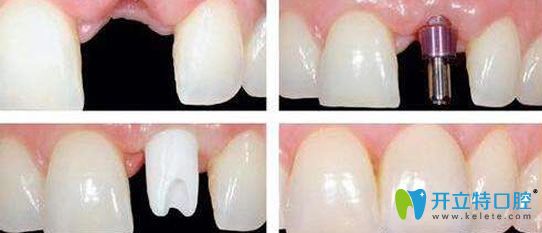 瑞安口腔趙俊仙醫(yī)生單顆牙種植案例 瑞安口腔趙俊仙醫(yī)生單顆牙種植案例