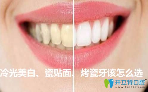 冷光美白和牙齒瓷貼面及烤瓷牙該怎么選?來看價(jià)格是多少錢