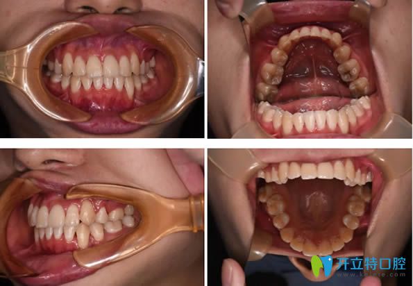 在鄭州拜博口腔做完自鎖托槽矯正器24個月的效果