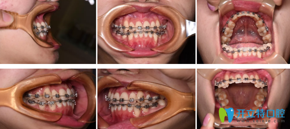 拜博口腔牙齒矯正18個月效果