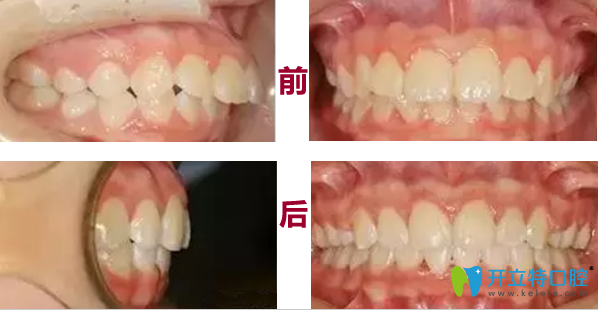 太原眾牙口腔牙齒矯正前后對比圖