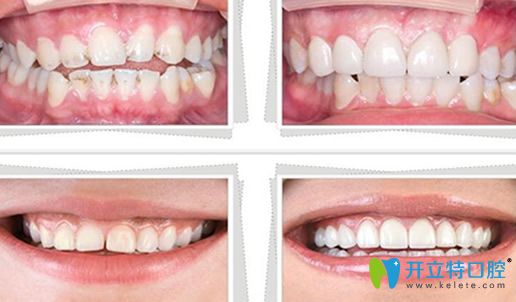 去西妃口腔做牙貼面治療前后案例對比圖