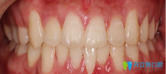 成都瑞安口腔牙齒矯正后效果圖 成都瑞安口腔牙齒矯正后效果圖