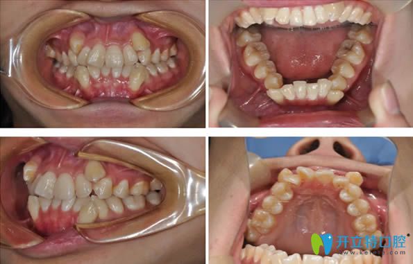 26歲的我，在鄭州拜博口腔花1萬多元做了自鎖托槽牙齒矯正